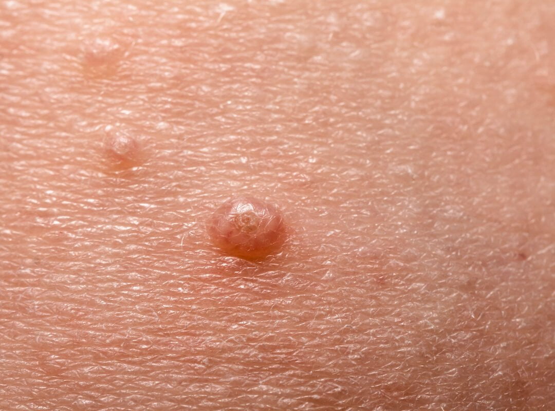 Treating Molluscum in Autism – One Mom’s Story